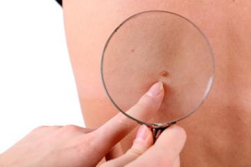 Settimana del melanoma. Mercoledì 9 maggio 2018 ambulatori Croce Azzurra di Pontassieve Settimana del melanoma. Mercoledì 9 maggio 2018 ambulatori Croce Azzurra di Pontassieve